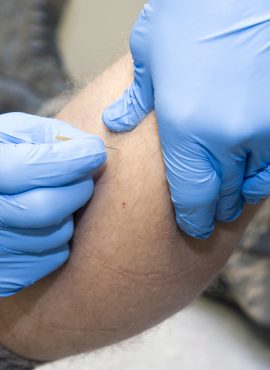 120605-F-VQ908-024 Dry Needling